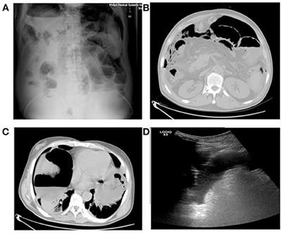 Cause Analysis and Diagnosis and Treatment of Intestinal Fistulas After Ultrasound-Guided Microwave Ablation of Abdominopelvic Lesions